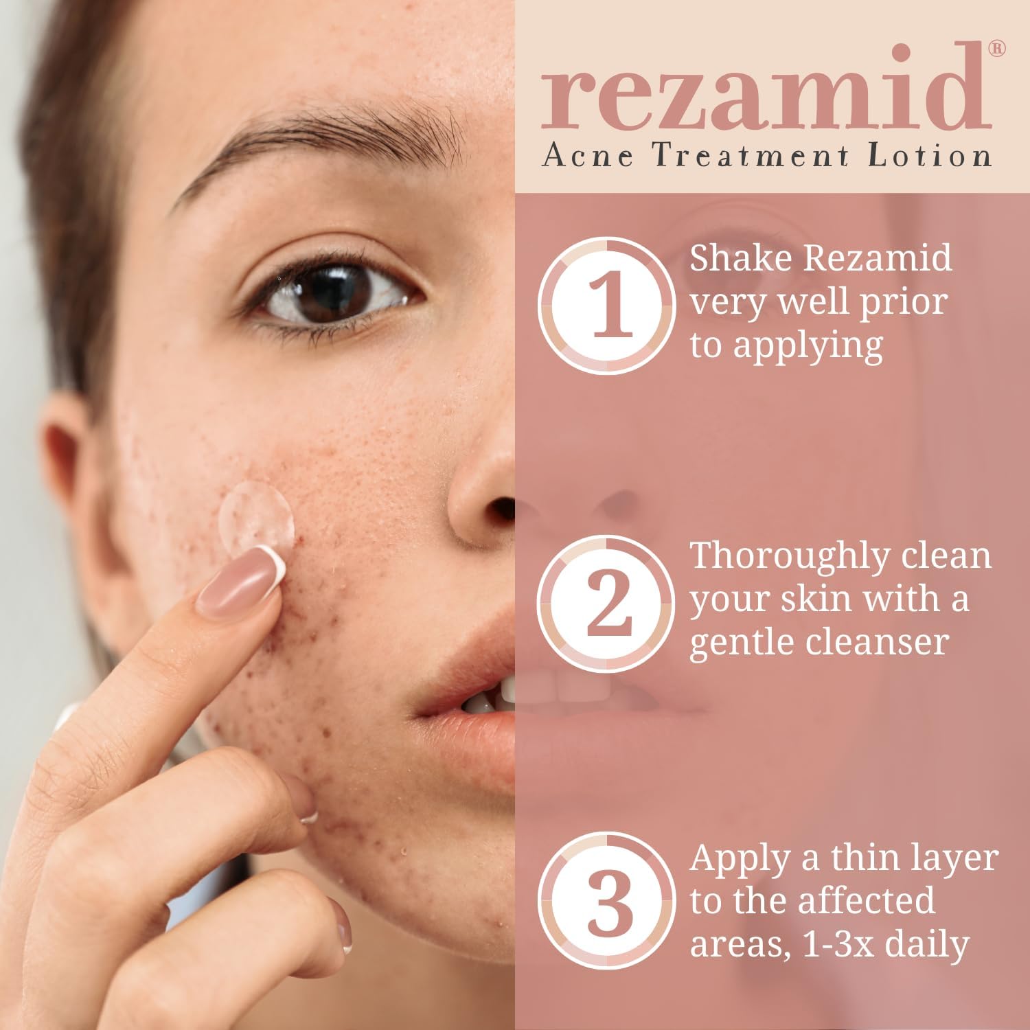 Rezamid Acne Lotion - Medicated Treatment for Clear Skin – Summers
