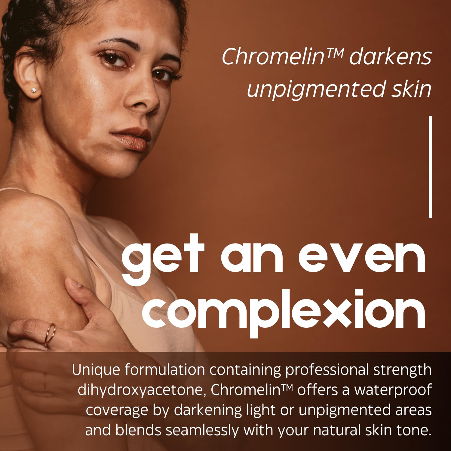 Chromelin Skin Dye for Vitiligo - Cosmetic Cover Solution 4oz